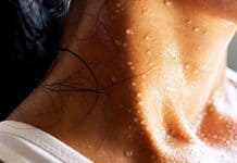 Suor excessivo pode indicar doença? Dermatologista Débora Cadore explica sinais de alerta da hiperidrose Pescoço e colo de uma mulher cobertos de gotas de suor, com regata branca